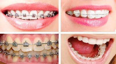 Tìm hiểu các phương pháp niềng răng nhanh nhất