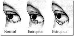 Eyelids-Normal-Entropion-Ectropion