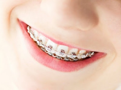 Niềng răng bằng mắc cài kim loại mất bao lâu thời gian?
