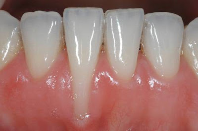 Có thể khắc phục niềng răng bị tụt lợi được không? 1