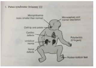 Trisomy 13 or Patau Syndrome 