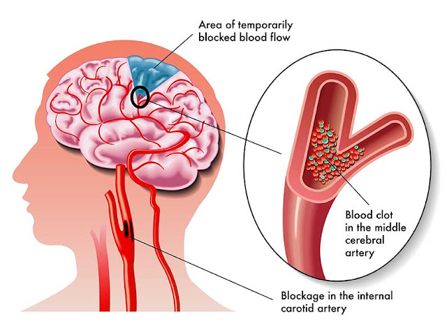 Penyebab penyakit stroke dan penyembuhannya