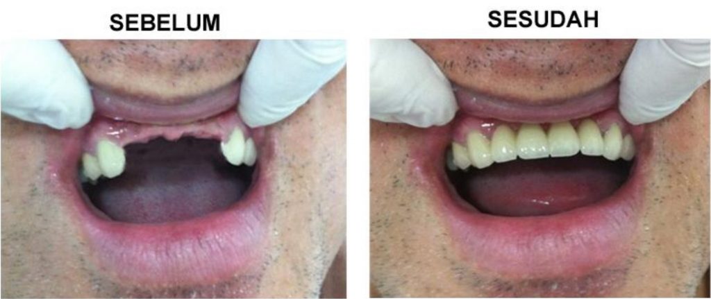   TERMURAH Harga Pasang  Gigi  Palsu Medan 2022
