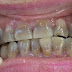 Vì sao răng bị xỉn màu kháng sinh? 