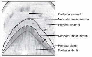 neonatal lines in enamel, neonatal lines in dentin