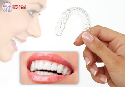 Niềng răng invisalign có đau không?