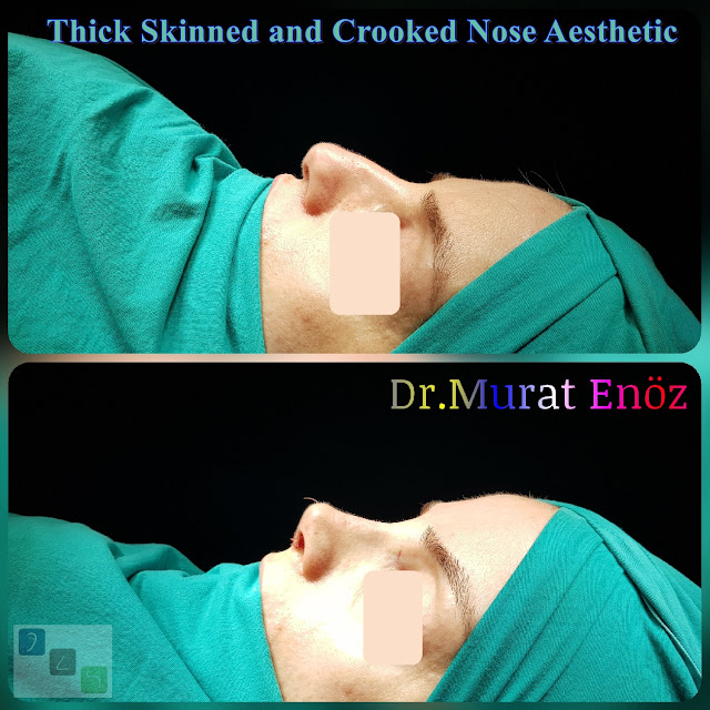 Crooked Nose Aesthetic,Female Nose Job, Rhinoplasty in Istanbul