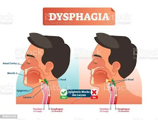 What Is Dysphagia