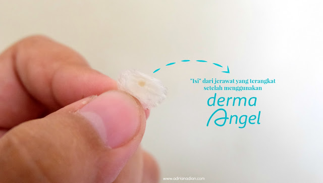 Acne Patch Derma Angel - Solusi masalah jerawat