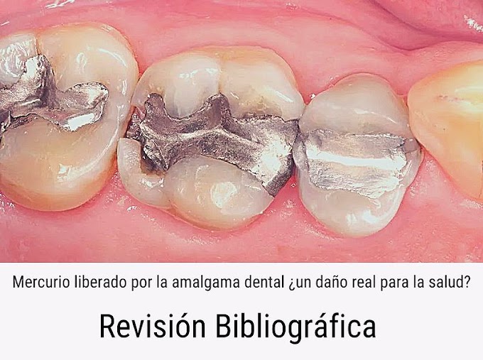 PDF: Mercurio liberado por la amalgama dental ¿un daño real para la salud?