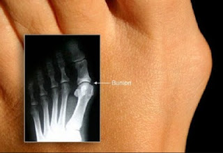 Dấu hiện khi bạn bị bunion