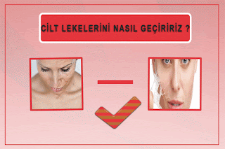 Cilt Lekeleri Nasıl Geçer