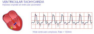 ventricular tachycardia causes
