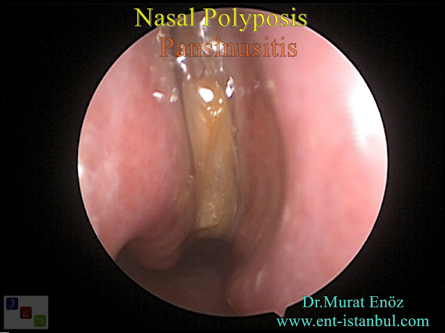 nasal polyposis pansinusitis