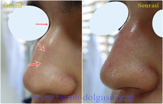 Burun Kökü Dolgusu - Burun Dolgusu - Dolguyla Burun estetiği - Non-surgical Nose Job In Istanbul - Dolgu İle Burun Ucu Kaldırma - Burun Ucu Dolgusu - Burun Dolgusu Fiyatı - Ameliyatsız Burun Estetiği - Burun Dolgusu Fiyatları - Dolgu İle Burun Kaldırma - Dolgu İle Burun Düzeltme