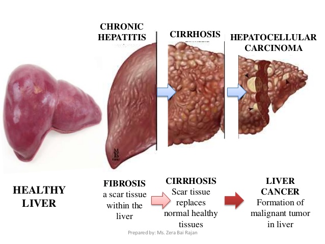  Fatty Liver Remedy