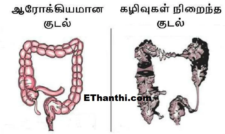 குடல் புற்றுநோய் பற்றி அறிந்து கொள்ள வேண்டிய முக்கிய அறிகுறிகள் !