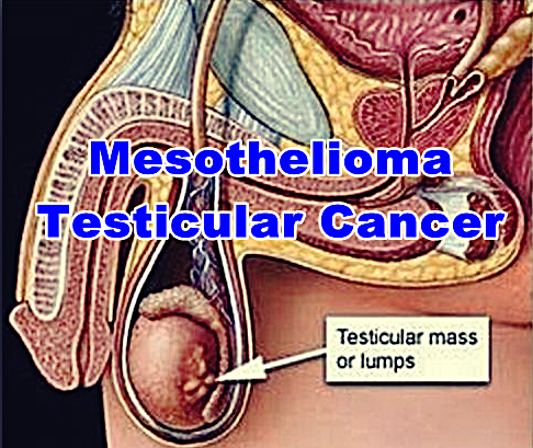 Mesothelioma Testicular Cancer