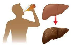 Ảnh hưởng nghiêm trọng của rượu đối với gan - Chẩn đoán và theo dõi qua xét nghiệm