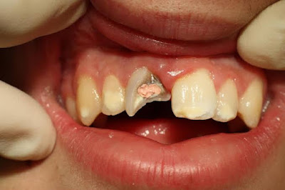 What Causes Root Infections?