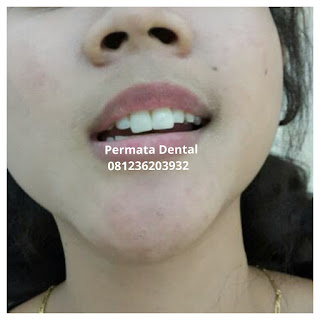 gambar foto contoh sebelum dan sesudah veneer gigi kelinci buatan manis cantik bali jember banyuwangi murah berkualitas di PERMATA DENTAL gambar gigi rusak yang di veneer gigi yang tidak rapi gigi renggang gigi patah cuil rompal pendek karies hitam kuning