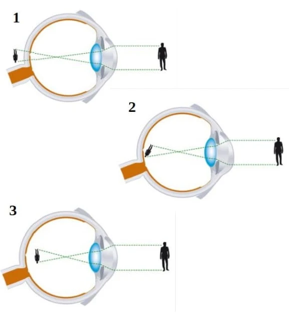 imagens a seguir mostram três problemas relacionados à visão