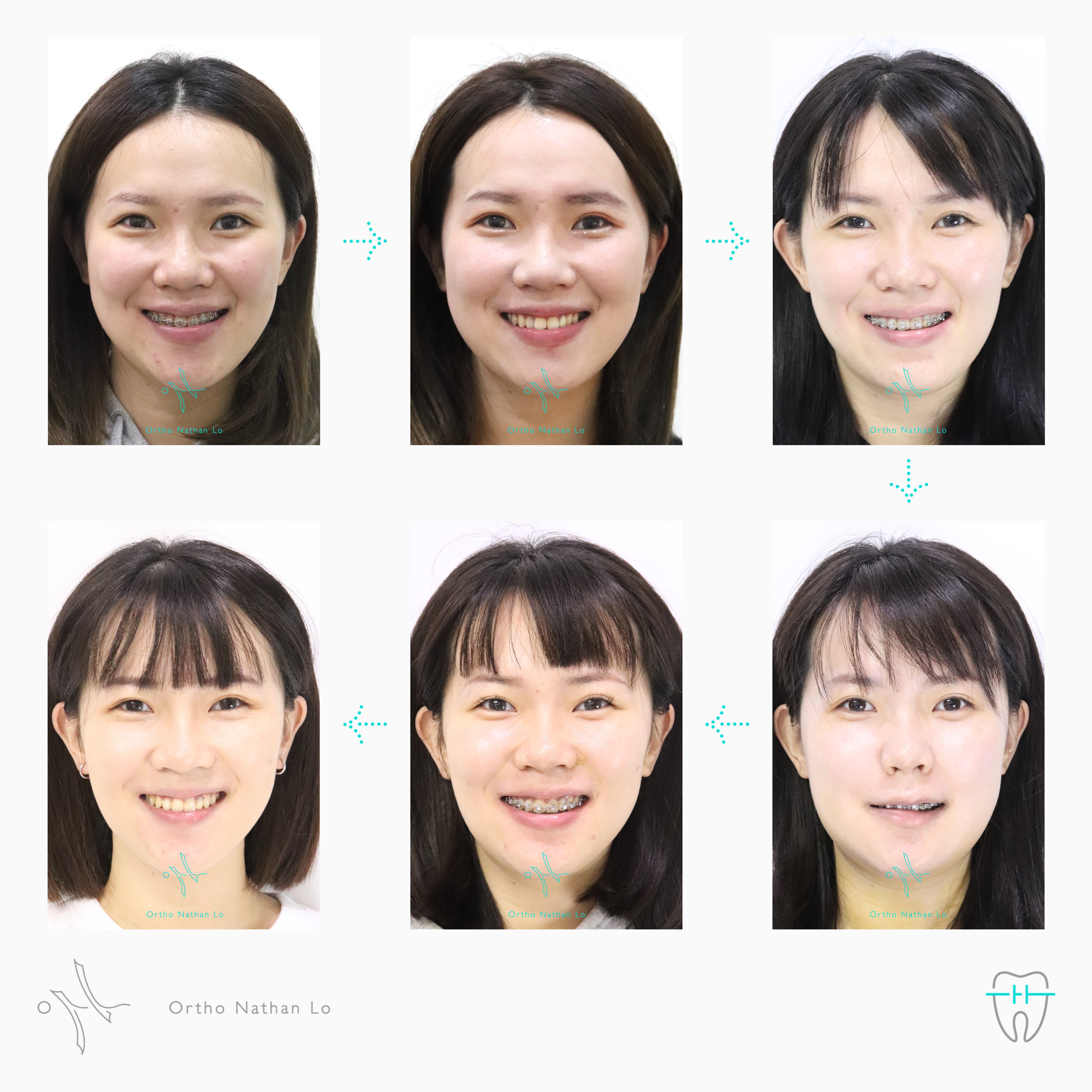 @orthonathanlo 矯正專科 羅書賢