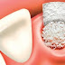 Phân tích từ bác sĩ màng trắng sau khi nhổ răng là gì