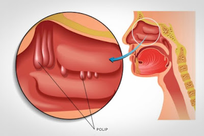 Cara Menyembuhkan Penyakit Polip Pada Hidung