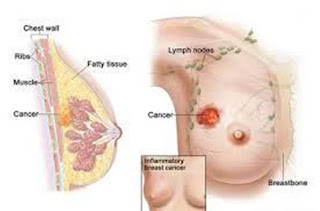 obat kanker payudara dari herbal, kanker payudara female daily, kanker payudara pada ibu menyusui, pengobatan kanker payudara.com, kanker payudara umur berapa, obat herbal cegah kanker payudara, pengobatan kanker payudara stadium 0, herbal penyakit kanker payudara, kanker payudara hamil, kanker payudara bisakah sembuh, kanker payudara dan obat nya, pengobatan bekam untuk kanker payudara, ramuan herbal pencegah kanker payudara, ciri2 kanker payudara stadium 3, cara membuat obat herbal kanker payudara, pengobatan kanker payudara tanpa operasi, cara pengobatan kanker payudara stadium 3, pengobatan kanker payudara selain operasi, kanker payudara dan cara pencegahannya, kanker payudara kemoterapi, obat alami kanker payudara stadium 3, buah yang mengobati kanker payudara, bahaya kanker payudara stadium 3, kanker payudara herbal, kanker payudara dan ibu menyusui, kanker payudara epidemiologi, penyembuhan kanker payudara alami