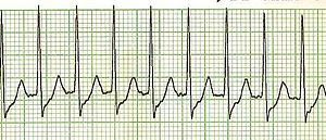 陣發性心室上心搏過速 Paroxysmal supraventricular tachycarida, PSVT