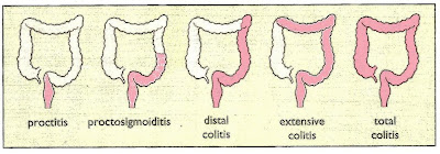 How does Ulcerative Colitis affect the gut ?