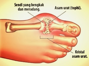 Ciri dan Tanda-Tanda Sakit Asam Urat