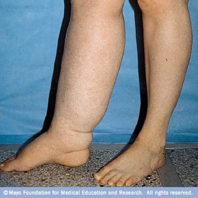 shoes  lymphedema can An feet be example of swelling how severe for