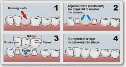 Dental Bridges