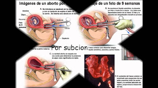 imagens de aborto