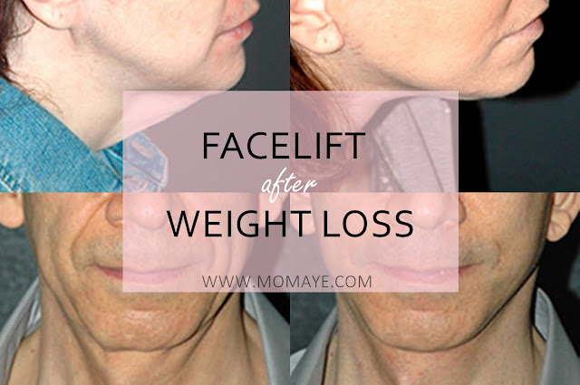 facelift, health, weight loss