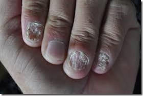 Psoriase E Suas Formas Nas Estradas Do Planeta