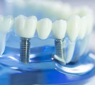 dental implant header