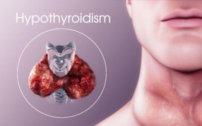 Steps On How To Lose Weight While Having Hypothyroidism