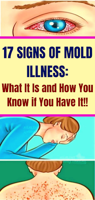 17 Signs Of Mоld Illnеss: Whаt It Is аnd Hоw Yоu Knоw if Yоu Hаvе It!!