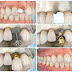 Cắm ghép Implant răng hàm như thế nào ?
