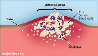 staphylococcal bacteria under the skin which causes the impetigo