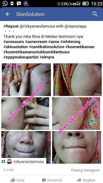 anti jerawat, acne, penghilang bekas jerawat, skin care, kosmetik