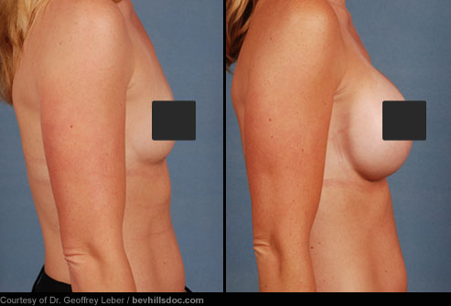 breast augmentation before and after c. Breast Implants: Before amp;