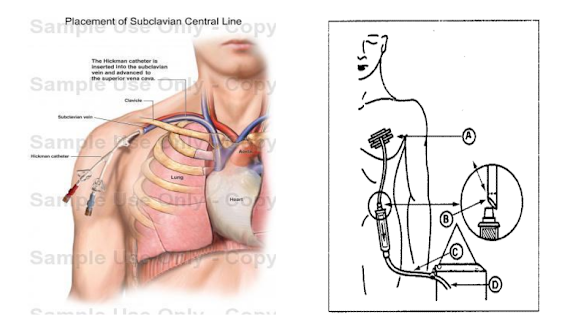 CVA Question and answer Medical coding CPT