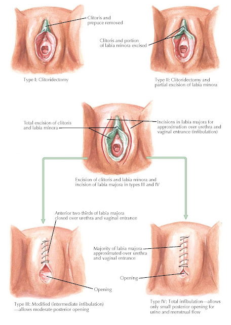 FEMALE CIRCUMCISION