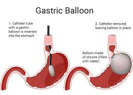 Gastric Balloon in Dubai