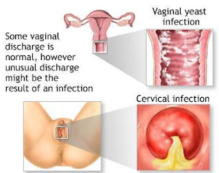 PENYAKIT APA JIKA LUKA LECET GATAL VAGINA DAN ANUS