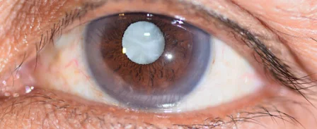 symptoms of cataract